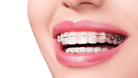 <strong>Niềng răng: Nhiều lợi ích nhưng cũng…nhiều biến chứng</strong>