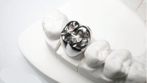 <strong>Bọc răng sứ kim loại là gì? Ưu, nhược điểm và giá cả thế nào?</strong>