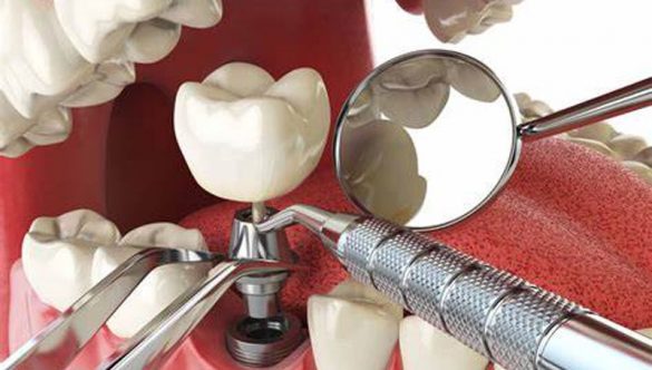 Cùng Phúc An Dental tìm hiểu 3 phần cấu tạo răng Implant