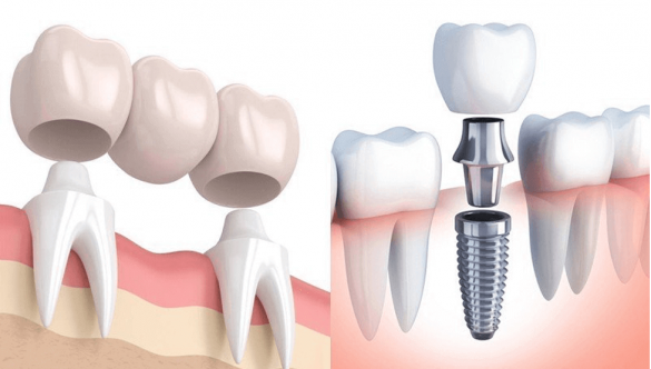 Trồng răng Implant và trồng răng sứ: Khác nhau ra sao?