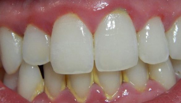 Mách nhỏ mẹo ngăn ngừa cao răng bạn nên bỏ túi ngay