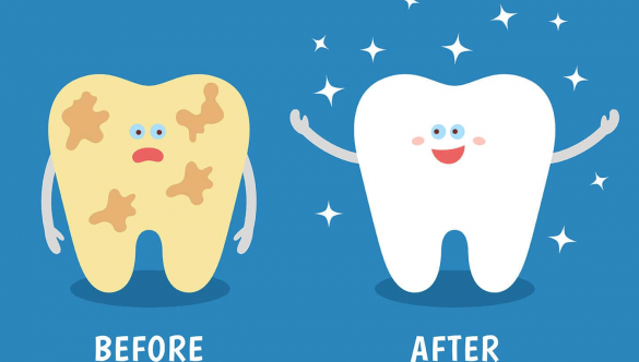 Tại sao nên cạo vôi răng? Quy trình và các lưu ý cần biết