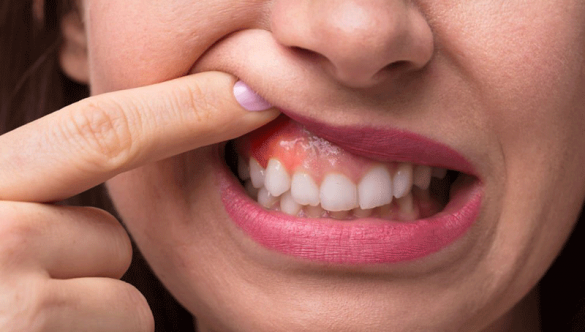 Cách phòng ngừa sưng nướu răng, chảy máu chân răng