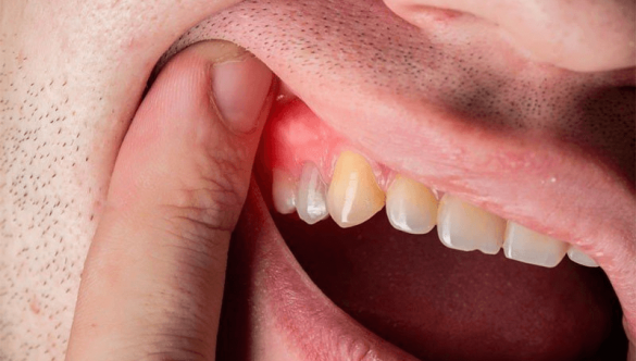 Áp xe răng là gì? Cách phòng ngừa và điều trị hiệu quả