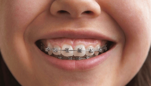 Răng hô là gì? Những phương pháp niềng răng hô