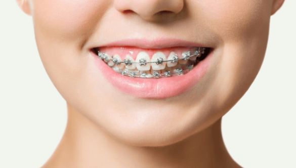 Quy trình niềng răng hô – Những gì bạn cần biết