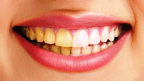 10 nguyên nhân gây ra răng ố vàng
