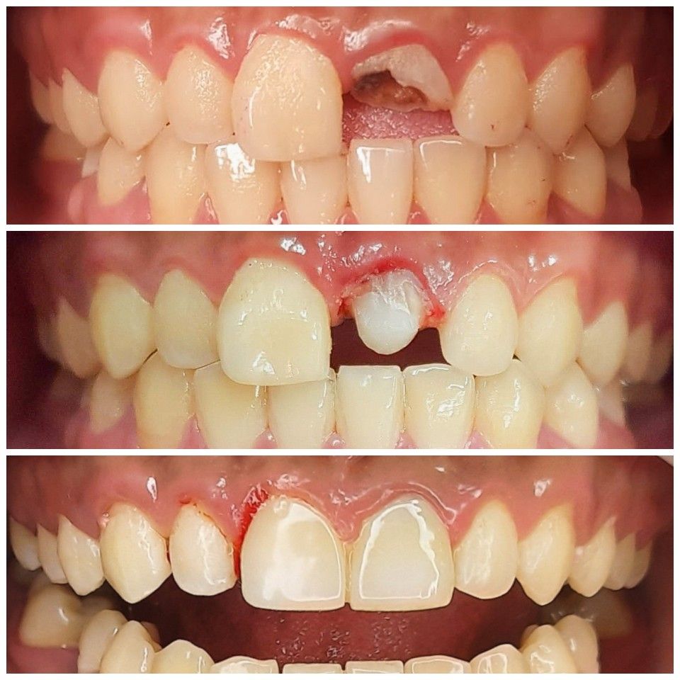 Bọc Răng Sứ Thẩm Mỹ – Giải Pháp Phục Hình Nụ Cười  (2)