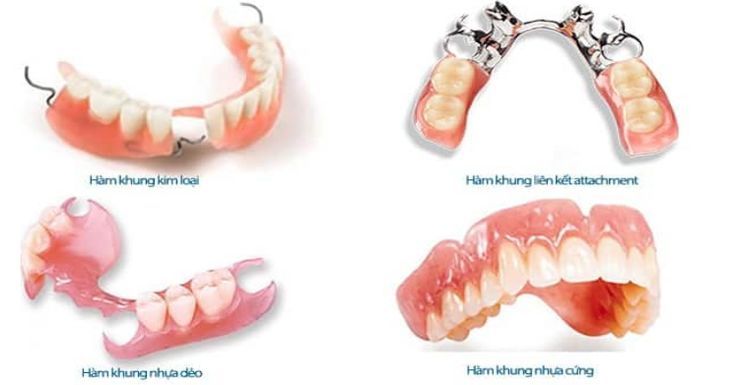 Các Phương Pháp Phục Hình Răng Mất Phổ Biến Hiện Nay