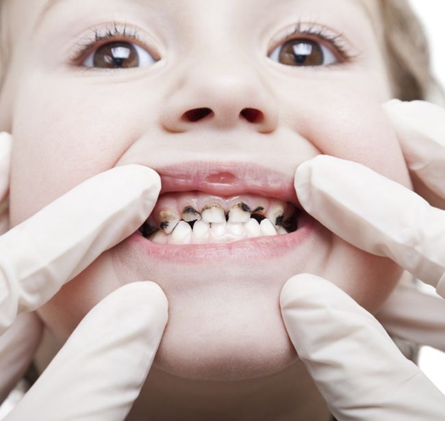 Cảnh Báo Dấu Hiệu Sâu Răng Ở Trẻ – Ba Mẹ Cần Biết