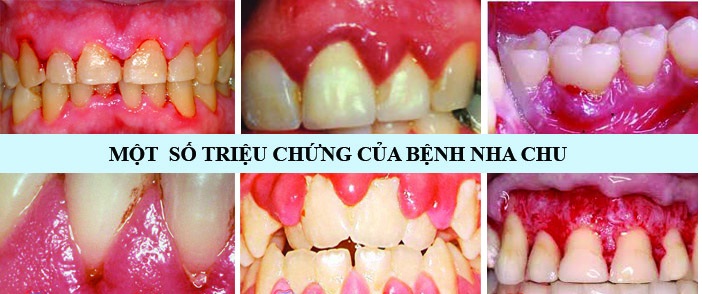 Dấu Hiệu Viêm Nha Chu Gây Nguy Hiểm