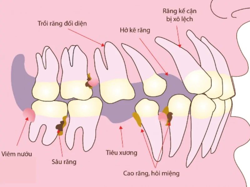 Mất Răng Nguy Hiểm Như Thế Nào (1)