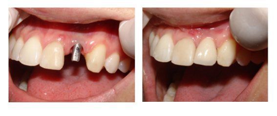 Trồng Răng Implant – Giải Pháp Phục Hình Răng Mất Toàn Diện Tại Nha Khoa Phúc An (2)
