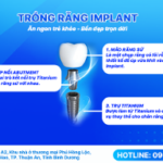Các giai đoạn trong quy trình trồng răng implant từ thăm khám đến gắn mão sứ