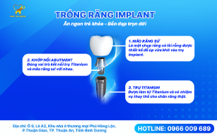 Các giai đoạn trong quy trình trồng răng implant từ thăm khám đến gắn mão sứ